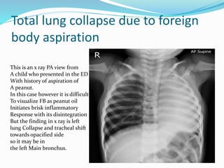 Total lung collapse due to foreign
body aspiration
This is an x ray PA view from
A child who presented in the ED
With history of aspiration of
A peanut.
In this case however it is difficult
To visualize FB as peanut oil
Initiates brisk inflammatory
Response with its disintegration
But the finding in x ray is left
lung Collapse and tracheal shift
towards opacified side
so it may be in
the left Main bronchus.
 