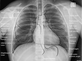 Before going to our topic lets have
a look at normal chest X ray PA
view and structures normally
visualize in it
 