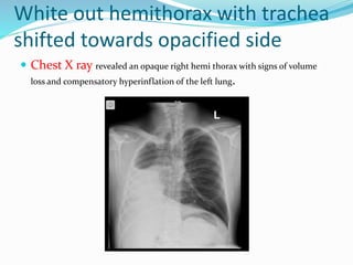 White out hemithorax with trachea
shifted towards opacified side
 Chest X ray revealed an opaque right hemi thorax with signs of volume
loss and compensatory hyperinflation of the left lung.
 