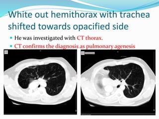 White out hemithorax with trachea
shifted towards opacified side
 He was investigated with CT thorax.
 CT confirms the diagnosis as pulmonary agenesis
 