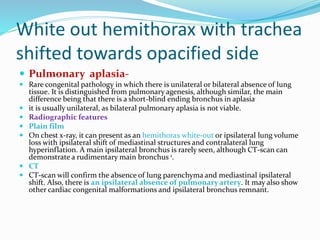 White out hemithorax with trachea
shifted towards opacified side
 Pulmonary aplasia-
 Rare congenital pathology in which there is unilateral or bilateral absence of lung
tissue. It is distinguished from pulmonary agenesis, although similar, the main
difference being that there is a short-blind ending bronchus in aplasia.
 it is usually unilateral, as bilateral pulmonary aplasia is not viable.
 Radiographic features
 Plain film
 On chest x-ray, it can present as an hemithorax white-out or ipsilateral lung volume
loss with ipsilateral shift of mediastinal structures and contralateral lung
hyperinflation. A main ipsilateral bronchus is rarely seen, although CT-scan can
demonstrate a rudimentary main bronchus 1.
 CT
 CT-scan will confirm the absence of lung parenchyma and mediastinal ipsilateral
shift. Also, there is an ipsilateral absence of pulmonary artery. It may also show
other cardiac congenital malformations and ipsilateral bronchus remnant.
 