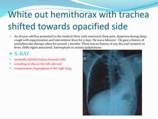 White out hemithorax with trachea
shifted towards opacified side
 An 18-year-old boy presented to the medical clinic with exertional chest pain, dyspnoea during sleep,
cough with expectoration and intermittent fever for 5 days. He was a labourer . He gave a history of
antitubercular therapy taken for around 3 months. There was no history of any diu.rnal variation in
fever, chills/rigors associated, haemoptysis or anxiety/palpitations.
 X-RAY
 markedly shifted trachea (towards left),
 crowding of ribs on the left side and
 compensatory hyperplasia of the right lung.
 