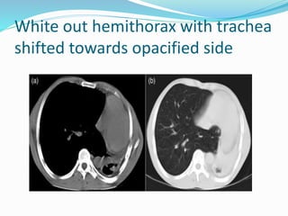 White out hemithorax with trachea
shifted towards opacified side
 