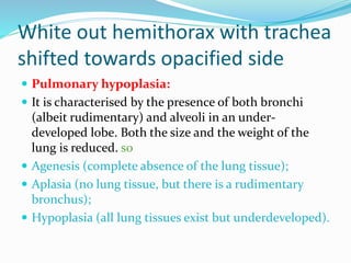 White out hemithorax with trachea
shifted towards opacified side
 Pulmonary hypoplasia:
 It is characterised by the presence of both bronchi
(albeit rudimentary) and alveoli in an under-
developed lobe. Both the size and the weight of the
lung is reduced. so
 Agenesis (complete absence of the lung tissue);
 Aplasia (no lung tissue, but there is a rudimentary
bronchus);
 Hypoplasia (all lung tissues exist but underdeveloped).
 