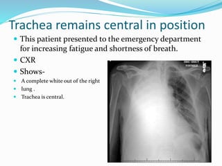 Trachea remains central in position
 This patient presented to the emergency department
for increasing fatigue and shortness of breath.
 CXR
 Shows-
 A complete white out of the right
 lung .
 Trachea is central.
 