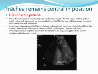Trachea remains central in position
 USG of same patient-
 This is the appearance of consolidated lung (in this case, cancer). Normal lung is air filled and not
readily visible with ultrasound, but in consolidation as fluid fills the lung and displaces air the lung is
easier to visualize with ultrasound.
 In this image its easy to see the difference between collapsed lung (from cancer) and pleural fluid, but
in some cases complex effusions can be more difficult to distinguish. You can look for air
bronchograms (small bright reflectors from air trapped in the lung), or doppler can be used to
visualize small pulmonary vessels.
 