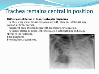 Trachea remains central in position
Diffuse consolidation in bronchoalveolar carcinoma
The chest x-ray shows diffuse consolidation with 'white out' of the left lung
with an air-bronchogram.
This patient had a chronic disease with progressive consolidation.
The disease started as a persitent consolidation in the left lung and finally
spread to the right lung.
Final diagnosis:
bronchoalveolar carcinoma.
 