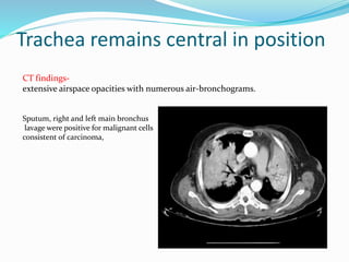 Trachea remains central in position
CT findings-
extensive airspace opacities with numerous air-bronchograms.
Sputum, right and left main bronchus
lavage were positive for malignant cells
consistent of carcinoma,
 