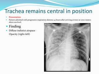 Trachea remains central in position
 Presentation
 Patient admitted with progressive respiratory distress 24 hours after arriving at town at 2700 meters
above sea level.
 Finding
 Diffuse indistict airspace
Opacity (right>left)
 