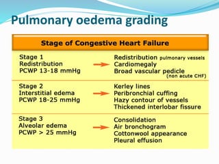 Pulmonary oedema grading
 grade 0: normal chest radiograph, PCWP 8-12 mmHg
 grade 1: shows evidence of upper lobe diversion on a
chest radiograph, PCWP 13-18 mmHg
 grade 2: shows interstitial oedema on a chest
radiograph, PCWP 19-25 mmHg
 grade 3: shows alveolar oedema on a chest radiograph,
PCWP >25 mmHg
 