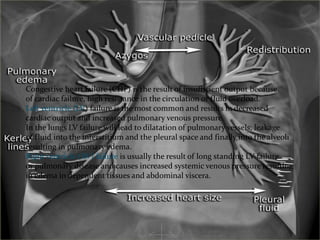 Cardiogenic pulmonary edema
Congestive heart failure (CHF) is the result of insufficient output because
of cardiac failure, high resistance in the circulation or fluid overload.
Left ventricle (LV) failure is the most common and results in decreased
cardiac output and increased pulmonary venous pressure.
In the lungs LV failure will lead to dilatation of pulmonary vessels, leakage
of fluid into the interstitium and the pleural space and finally into the alveoli
resulting in pulmonary edema.
Right ventricle (RV) failure is usually the result of long standing LV failure
or pulmonary disease and causes increased systemic venous pressure resulting
in edema in dependent tissues and abdominal viscera.
 