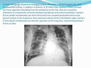 A chest radiograph showed an enlarged cardiac silhouette, a dilated azygos vein, and
peribronchial cuffing, in addition to Kerley's A, B, and C lines. Kerley's A lines (arrows)
are linear opacities extending from the periphery to the hila; they are caused by
distention of anastomotic channels between peripheral and central lymphatics. Kerley's
B lines (white arrowheads) are short horizontal lines situated perpendicularly to the
pleural surface at the lung base; they represent edema of the interlobular septa. Kerley's
C lines (black arrowheads) are reticular opacities at the lung base, representing Kerley's
B lines en face.
 