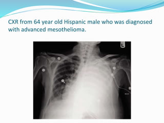 CXR from 64 year old Hispanic male who was diagnosed
with advanced mesothelioma.
 
