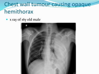 Chest wall tumour causing opaque
hemithorax
 x ray of 16y old male
 