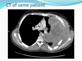 CT of same patient
 