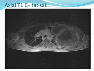 Axial T1 C+ fat sat
 