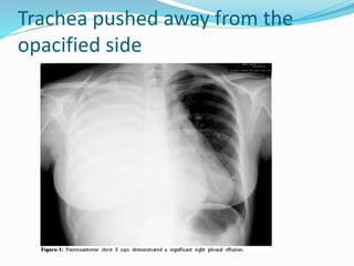 Trachea pushed away from the
opacified side
 