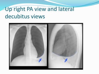 Up right PA view and lateral
decubitus views
 