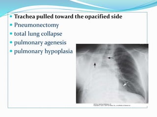  Trachea pulled toward the opacified side
 Pneumonectomy
 total lung collapse
 pulmonary agenesis
 pulmonary hypoplasia
 