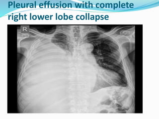 Pleural effusion with complete
right lower lobe collapse
 