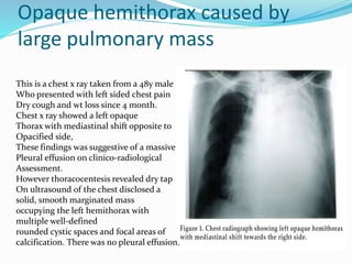 Opaque hemithorax caused by
large pulmonary mass
This is a chest x ray taken from a 48y male
Who presented with left sided chest pain
Dry cough and wt loss since 4 month.
Chest x ray showed a left opaque
Thorax with mediastinal shift opposite to
Opacified side,
These findings was suggestive of a massive
Pleural effusion on clinico-radiological
Assessment.
However thoracocentesis revealed dry tap
On ultrasound of the chest disclosed a
solid, smooth marginated mass
occupying the left hemithorax with
multiple well-defined
rounded cystic spaces and focal areas of
calcification. There was no pleural effusion.
 