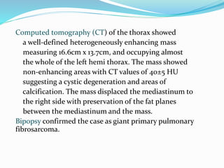 Computed tomography (CT) of the thorax showed
a well-defined heterogeneously enhancing mass
measuring 16.6cm x 13.7cm, and occupying almost
the whole of the left hemi thorax. The mass showed
non-enhancing areas with CT values of 40±5 HU
suggesting a cystic degeneration and areas of
calcification. The mass displaced the mediastinum to
the right side with preservation of the fat planes
between the mediastinum and the mass.
Bipopsy confirmed the case as giant primary pulmonary
fibrosarcoma.
 
