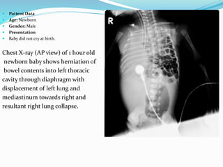  Patient Data
 Age: Newborn
 Gender: Male
 Presentation
 Baby did not cry at birth.
Chest X-ray (AP view) of 1 hour old
newborn baby shows herniation of
bowel contents into left thoracic
cavity through diaphragm with
displacement of left lung and
mediastinum towards right and
resultant right lung collapse.
 