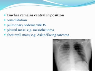  Trachea remains central in position
 consolidation
 pulmonary oedema/ARDS
 pleural mass: e.g. mesothelioma
 chest wall mass: e.g. Askin/Ewing sarcoma
 