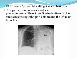  CXR from a 65 year old with right sided chest pain
 This patient has previously had a left
pneumonectomy. There is mediastinal shift to the left
and there are surgical clips visible around the left main
bronchus.
 
