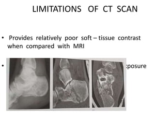 LIMITATIONS OF CT SCAN
• Provides relatively poor soft – tissue contrast
when compared with MRI
• Major diadvantage is - high radiation exposure
 