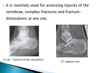  It is routinely used for assessing injuries of the
vertebrae, complex fractures and fracture-
dislocations at any site.
X-ray - fracture of the calcaneum
CT sagittal view
 