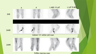 Positive Indium Scan Advanced Imaging Techniques in Osteomyelitis and Prosthesis Evaluation ...