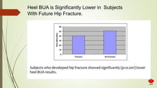 Heel BUA is Significantly Lower in Subjects
With Future Hip Fracture.
 
