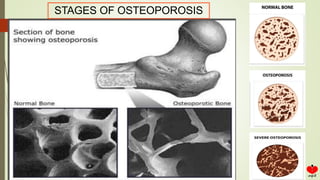 STAGES OF OSTEOPOROSIS
 