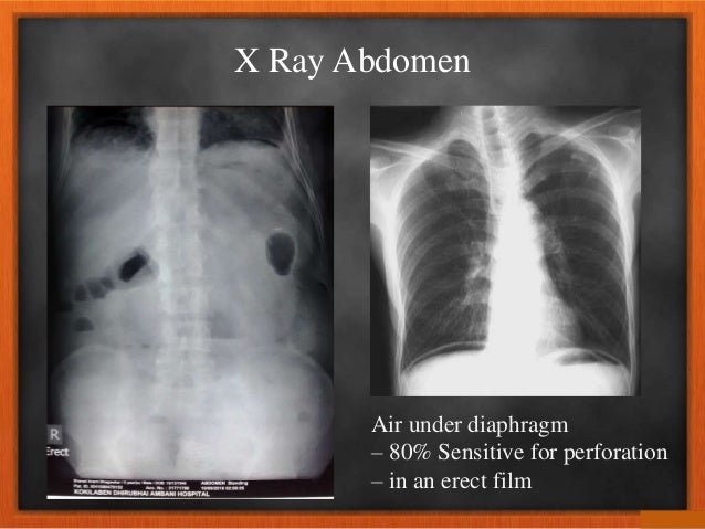 Imaging in pain abdomen