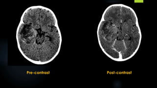 Pre-contrast Post-contrast
 