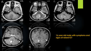 16 year old male with symptoms and
signs of raised ICT
 
