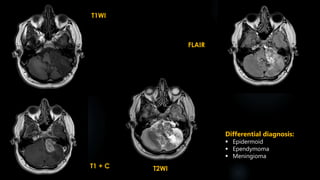 T1WI
T1 + C
FLAIR
T2WI
Differential diagnosis:
 Epidermoid
 Ependymoma
 Meningioma
 
