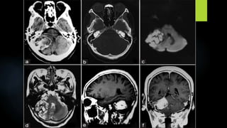 Imaging in pediatric brain tumors