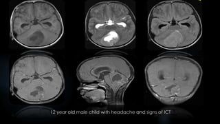 12 year old male child with headache and signs of ICT
 