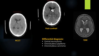 NCCT
Post-contrast
T2WI
Differential diagnosis:
 Central neurocytoma
 Choroid plexus papilloma
 Choroid plexus carcinoma
 