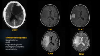 CECT T1WI
FLAIR T2WI
T1 + C
Differential diagnosis:
Ganglioglioma
DNET
Oligodendroglioma
Desmoplastic infantile
ganglioglioma
 