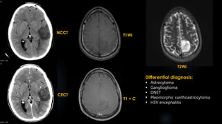 Differential diagnosis:
 Astrocytoma
 Ganglioglioma
 DNET
 Pleomorphic xanthoastrocytoma
 HSV encephalitis
NCCT
CECT
T1WI
T1 + C
T2WI
 