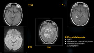T1WI
DWI T2WI
T1 + C
Differential diagnosis:
 DNET
 Pleomorphic xanthoastrocytoma
 Desmoplastic infantile
ganglioglioma
 