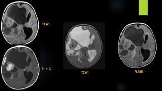 T2WI FLAIR
T1WI
T1 + C
 