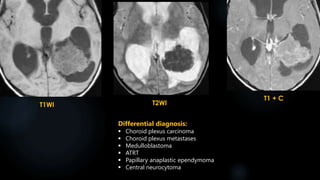 T1WI T2WI
T1 + C
Differential diagnosis:
 Choroid plexus carcinoma
 Choroid plexus metastases
 Medulloblastoma
 ATRT
 Papillary anaplastic ependymoma
 Central neurocytoma
 