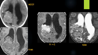 NCCT
T1WI
T1 + C T2WI
 