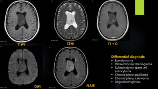 T1WI T1 + CT2WI
DWI FLAIR
Differential diagnosis:
 Ependymoma
 Intraventricular meningioma
 Subependymal giant cell
astrocytoma
 Choroid plexus papilloma
 Choroid plexus carcinoma
 Oligodendroglioma
 