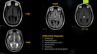 FLAIR
T1 + C
T1WI
T2WI
Differential diagnosis:
 Pineal cyst
 Pineoblastoma
 Pineal papillary tumor
 Germinoma
 Teratoma
 Astrocytoma of pineal gland
 