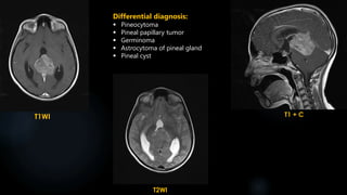 T1WI
T2WI
T1 + C
Differential diagnosis:
 Pineocytoma
 Pineal papillary tumor
 Germinoma
 Astrocytoma of pineal gland
 Pineal cyst
 